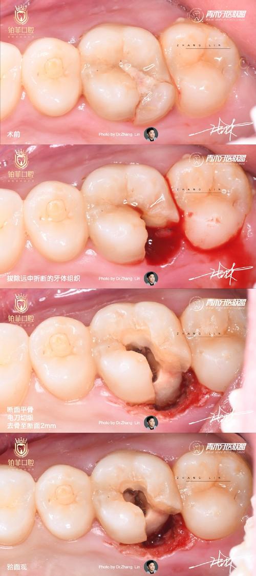 正畸时支抗钉发炎了-图3