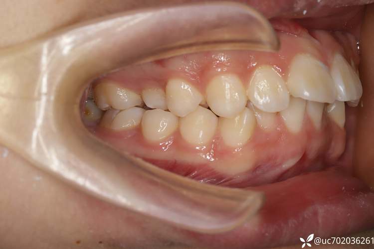 隐适美牙齿正畸拔牙-图3