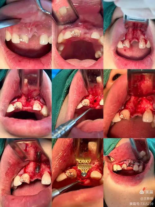 种牙植骨失败-图1