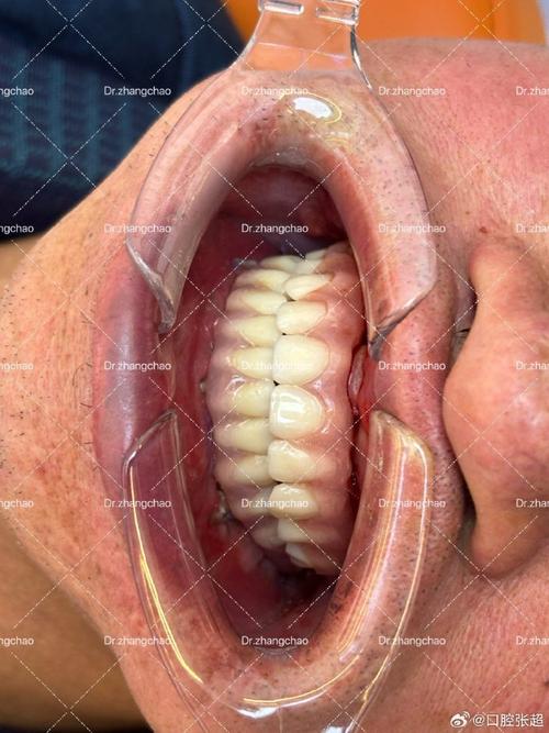 种牙骨量不足-图1