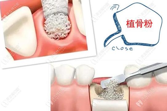 种牙骨粉吸收-图3