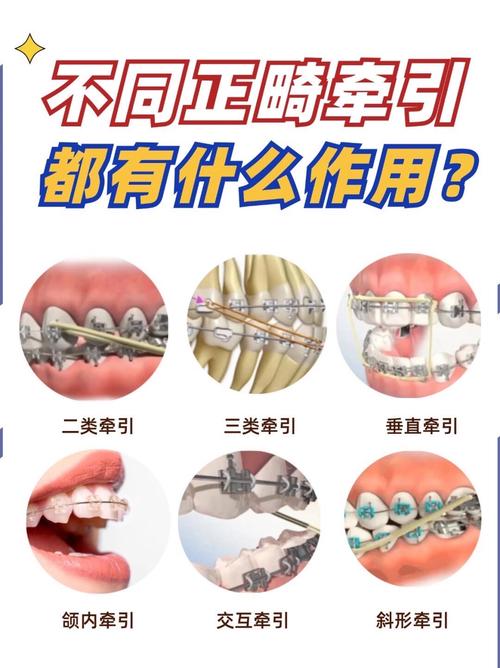 正畸牵引圈挂法分类-图2 正畸牵引圈挂法分类-图2