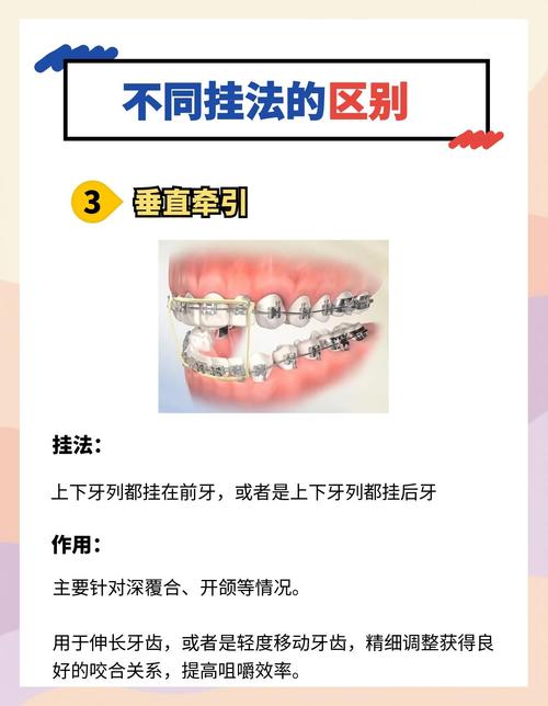 正畸牵引圈挂法分类-图3 正畸牵引圈挂法分类-图3