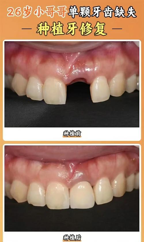 门牙种牙图片-图1