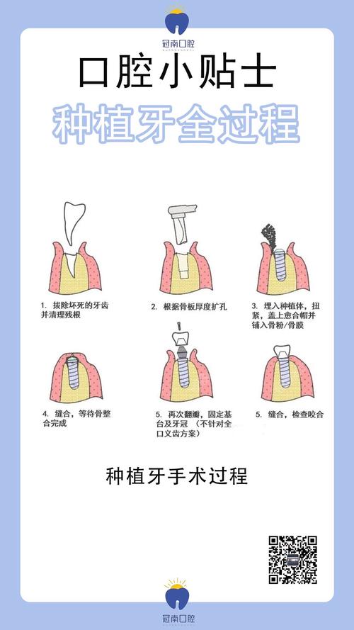种牙怎么植骨-图1
