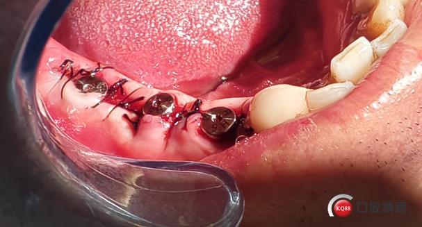 拔牙立刻种牙-图3