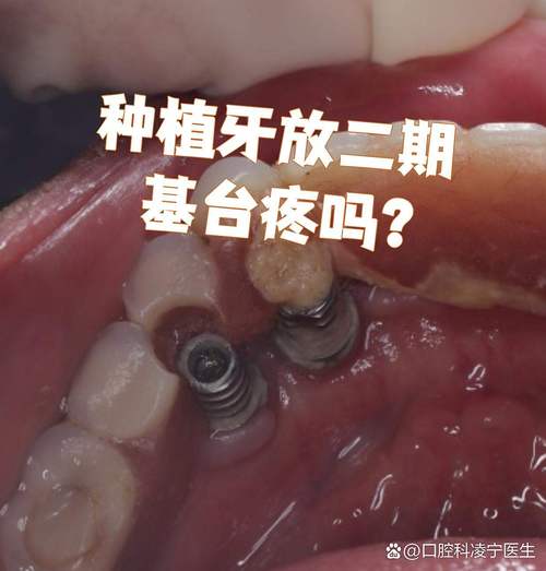 种牙安装基台-图1 种牙安装基台-图1