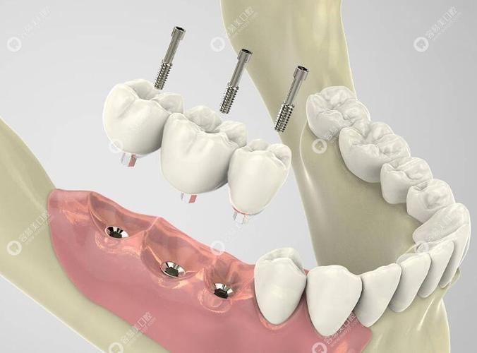 种牙安装基台-图3 种牙安装基台-图3