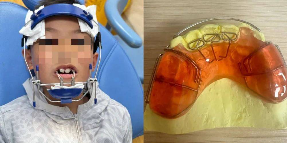 西安下兜齿正畸手术-图1