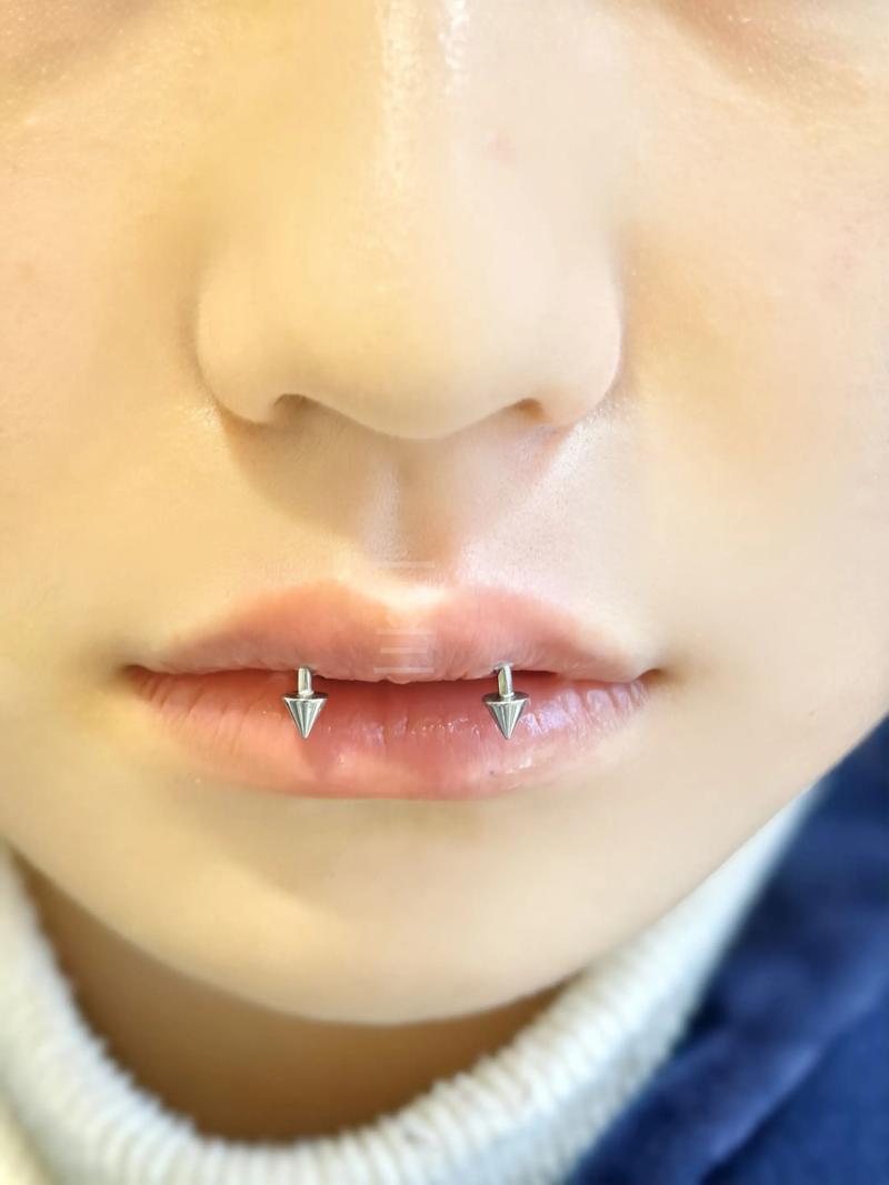 正畸牙钉是什么材质-图2