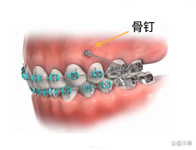正畸牙钉是什么材质-图3