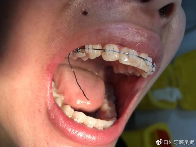 正畸弓丝串出来的操作步骤有哪些？-图2