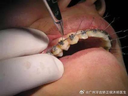 正畸弓丝串出来的操作步骤有哪些？-图1