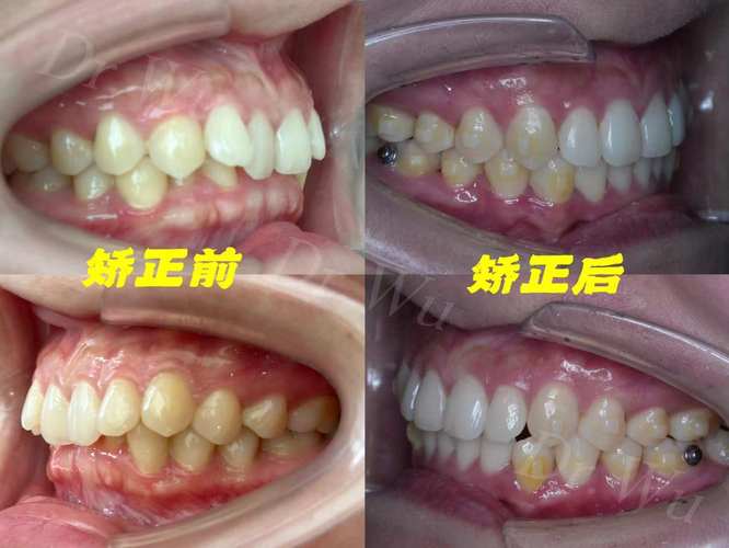 省口腔医院隐形正畸效果如何？价格与优势有哪些？-图3