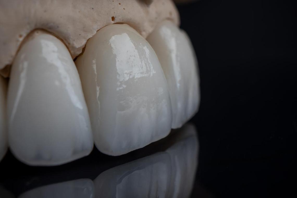 广州免费种牙-图3