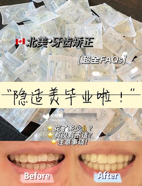 为什么隐适美正畸容易反弹？-图2