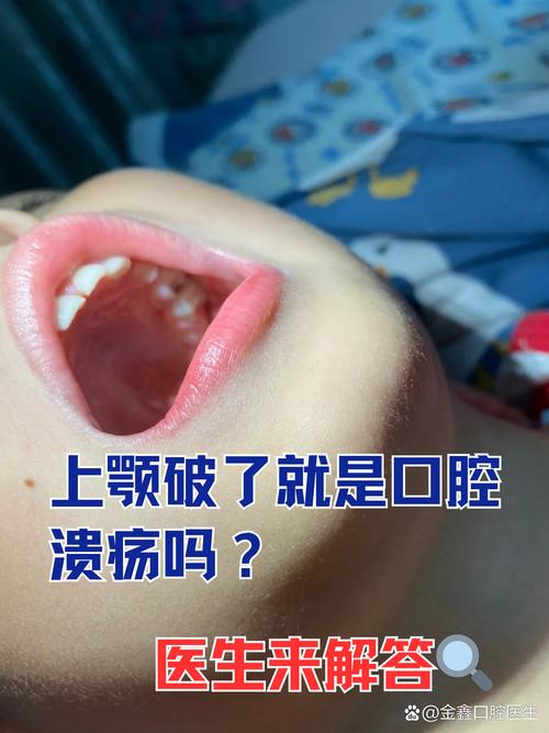 牙齿正畸期间口腔溃疡频发，该如何有效应对？-图2