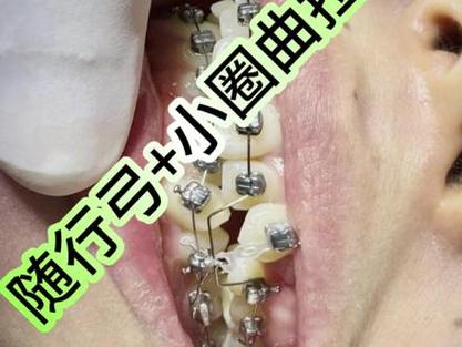 正畸拉尖牙向后方法-图2