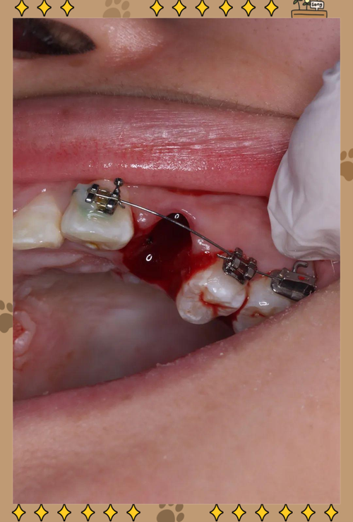 正畸牙可以不拔牙吗-图1