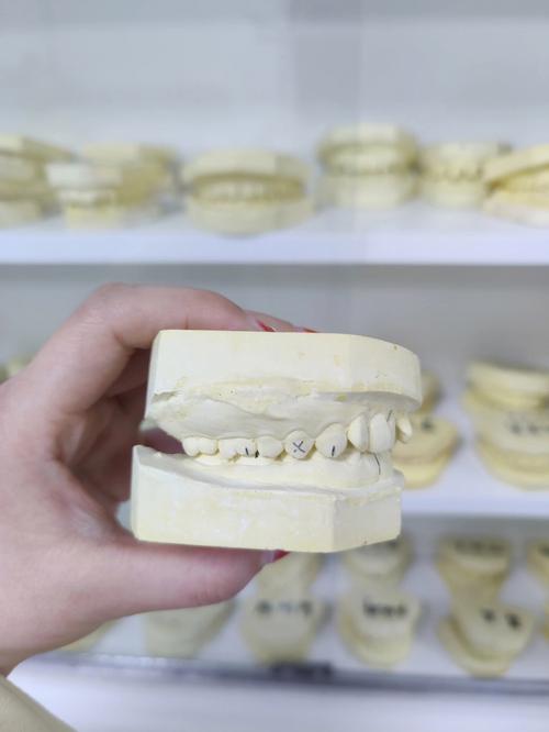 正畸后石膏模型到底有什么用？对牙齿维护和美观有何帮助？-图1