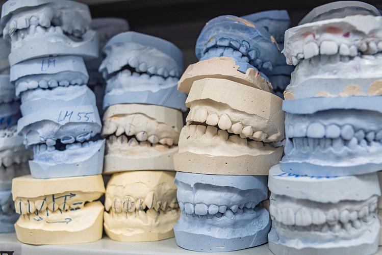 正畸后石膏模型到底有什么用？对牙齿维护和美观有何帮助？-图3