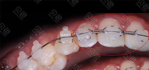 正畸8字结扎的手法-图3