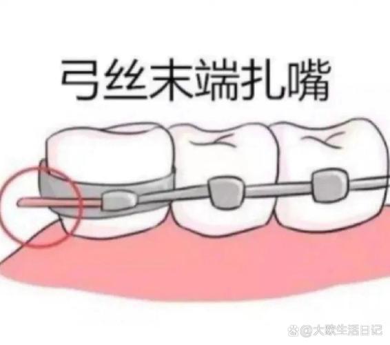 正畸8字结扎的手法-图1