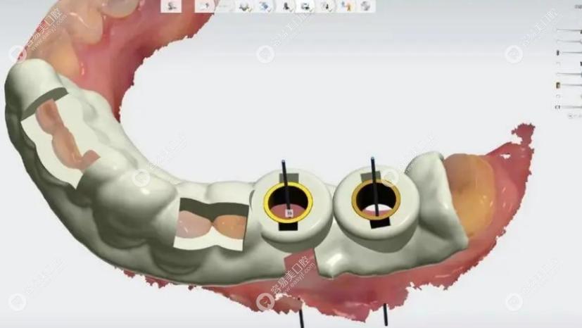 北京口腔医院 3d植牙-图2