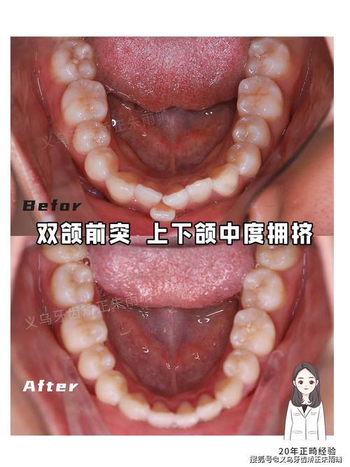 正畸牙弓拥挤9mm-图2