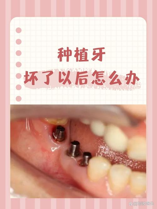 种植牙植骨失败了怎么办-图1