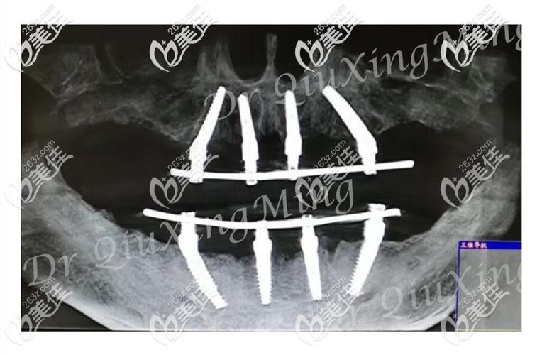 allon4种植牙全口-图1