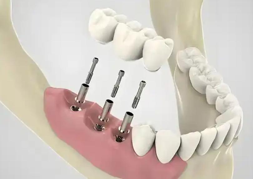 种植牙选植得还是赛思？从效果、价格看哪个更合适？-图2