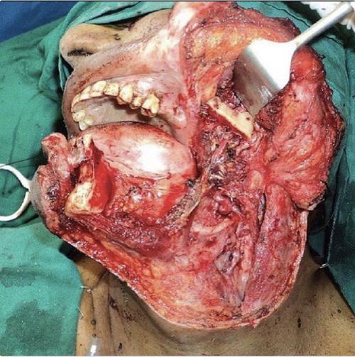 右下颌骨全切除能植牙吗-图3 右下颌骨全切除能植牙吗-图3