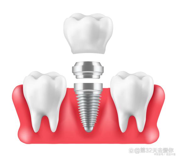 右下颌骨全切除能植牙吗-图2 右下颌骨全切除能植牙吗-图2