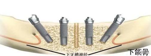 allon4种植牙取模-图3