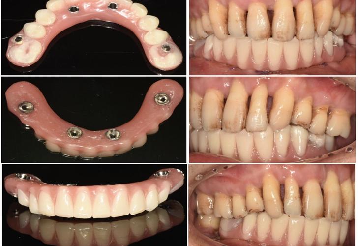 allon4种植牙取模-图1