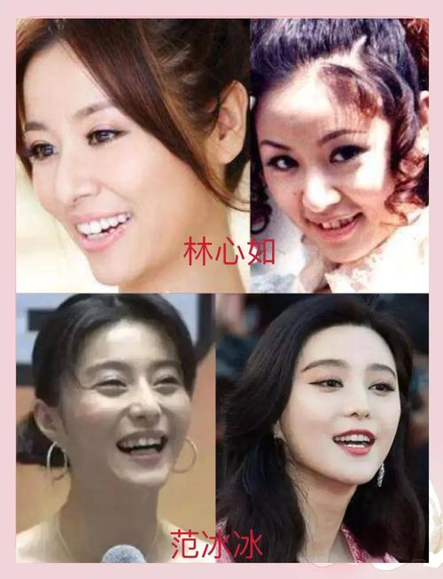 明星们正畸拔牙了吗-图1 明星们正畸拔牙了吗-图1