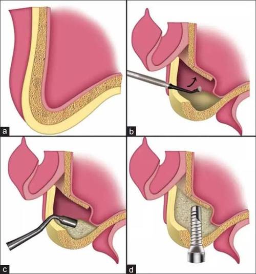 上颚植牙手术视频全过程-图3