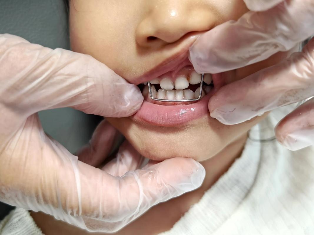 正畸牙齿地包天手术-图2