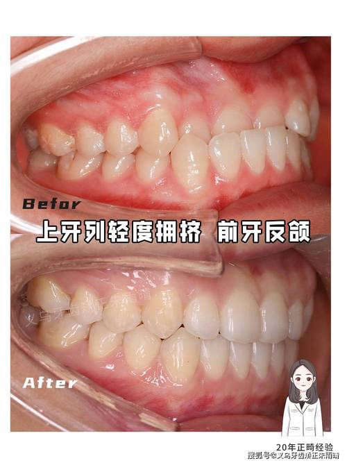 正畸牙齿地包天手术-图1