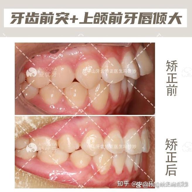中山牙齿正畸哪家好?选机构该看重口碑、技术还是效果?-图1 中山牙齿正畸哪家好?选机构该看重口碑、技术还是效果?-图1