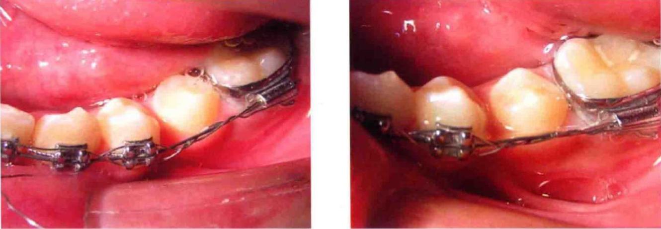 正畸结扎丝对折结扎-图1