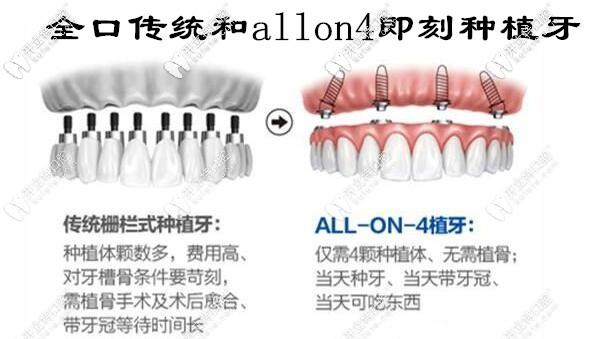 allon4种植牙费用多少？全口种植牙价格贵不贵？影响因素有哪些？-图2