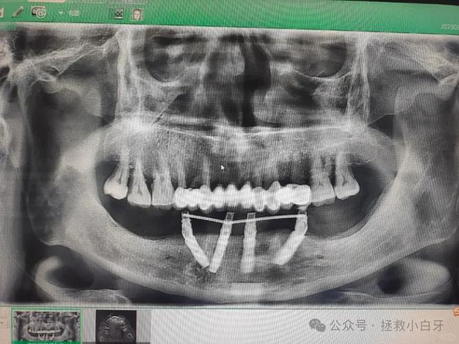 allon4种植牙需要满足哪些条件?-图1 allon4种植牙需要满足哪些条件?-图1