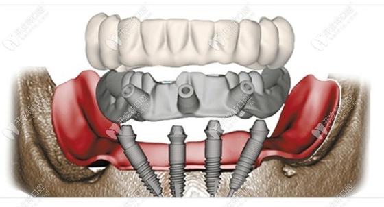 allon4种植牙需要满足哪些条件?-图2 allon4种植牙需要满足哪些条件?-图2