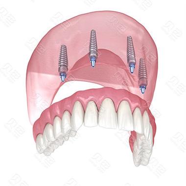 allon4种植牙需要满足哪些条件?-图3 allon4种植牙需要满足哪些条件?-图3