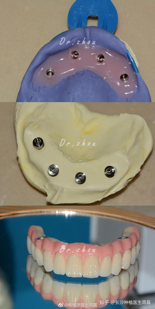深圳allon4种植牙-图3