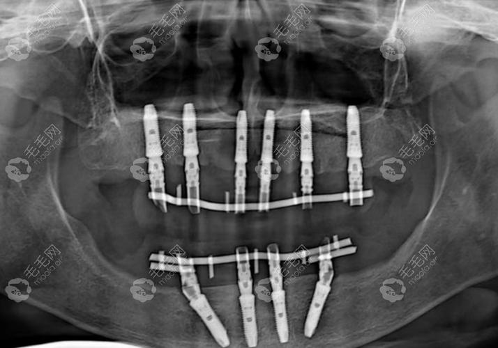 深圳allon4种植牙-图2