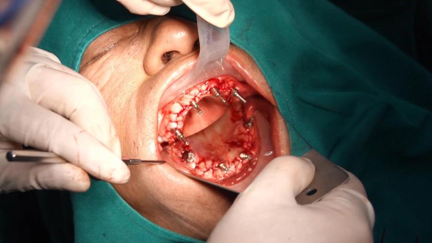 深圳allon4种植牙-图1