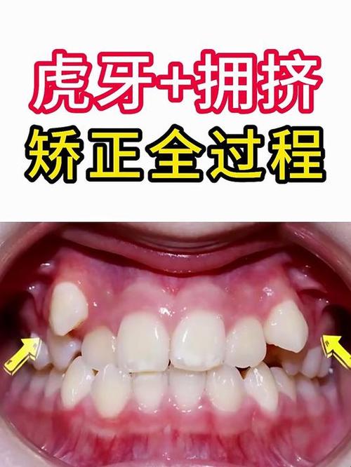 正畸推虎牙治疗方式-图2